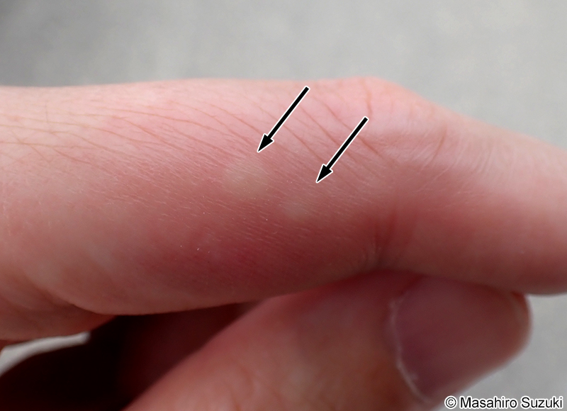 トビズムカデに咬まれた跡